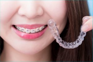 Diferencias entre ortodoncia tradicional y invisible