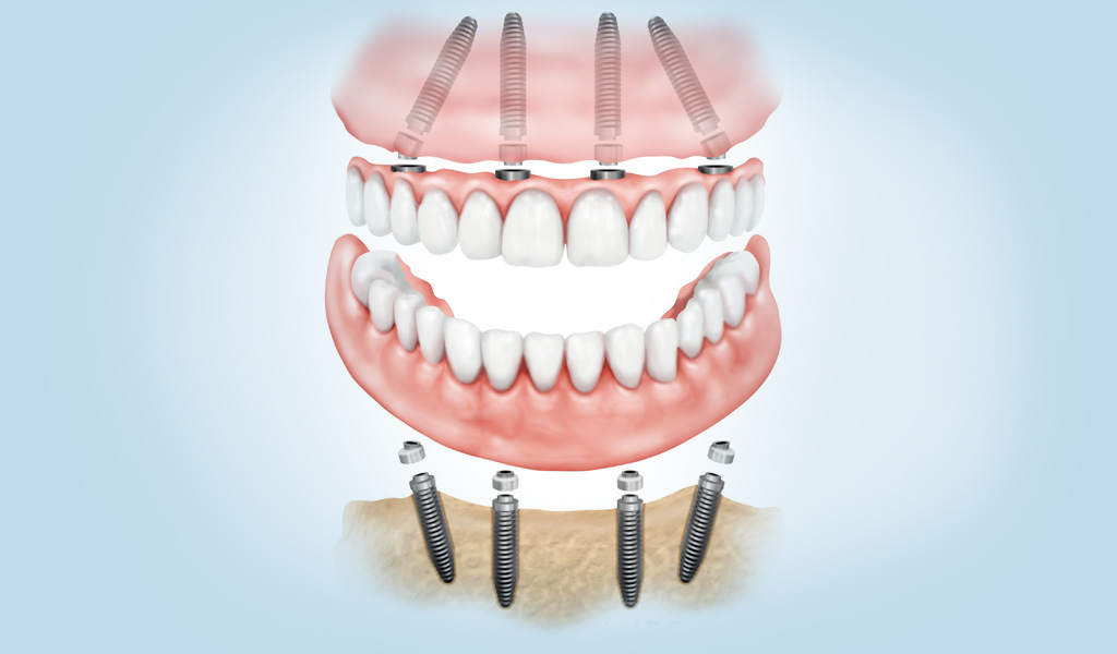 Implantes dentales en Eixample