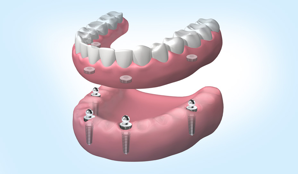 Implantes dentales en Eixample