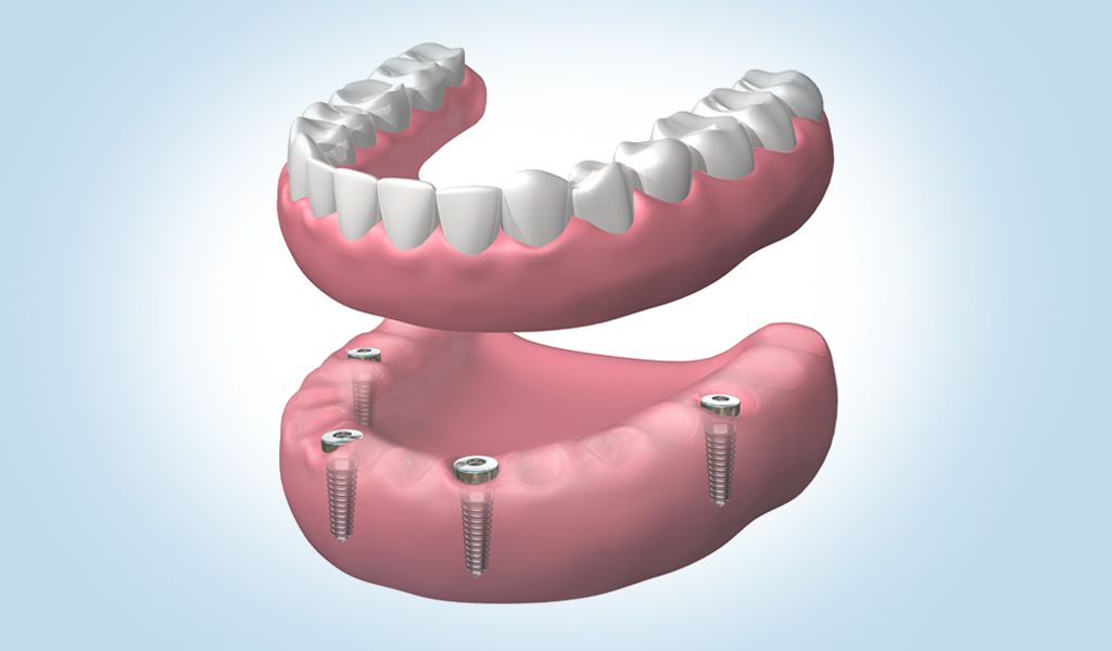 Implantes dentales en Eixample