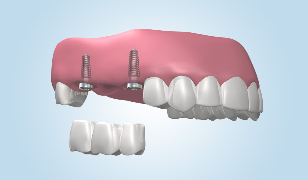 Implantes dentales en Eixample