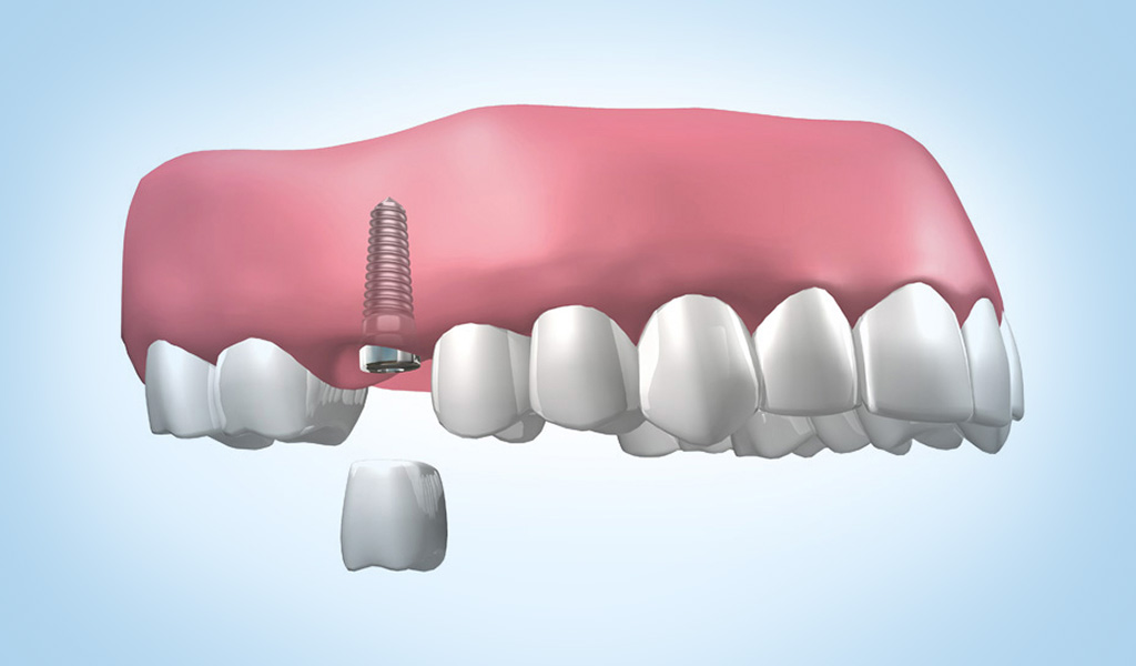 Implantes dentales en Eixample