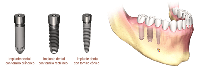 ¿Qué tipos de implantes dentales existen? | Dental Care Barcelona