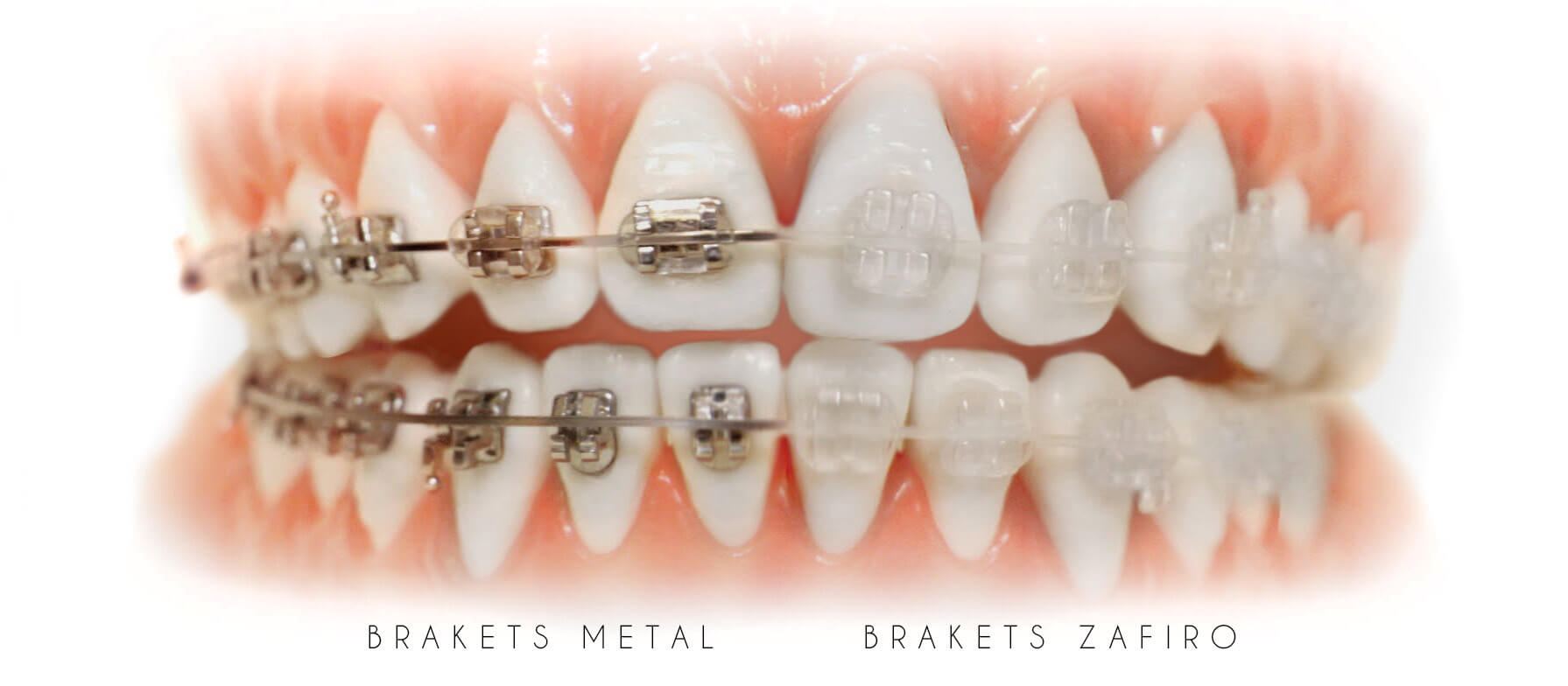 brackets-metal-vs-zafiro