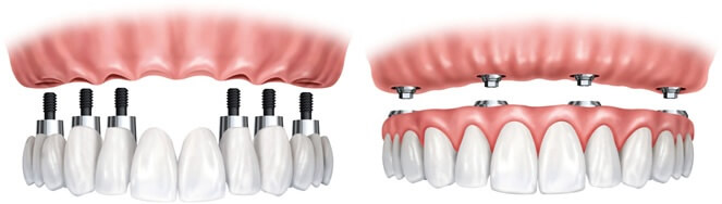 implantes-de-carga-inmediata-eixample