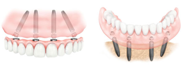 implantes-dentales-all-on-four-barcelona-el-eixample