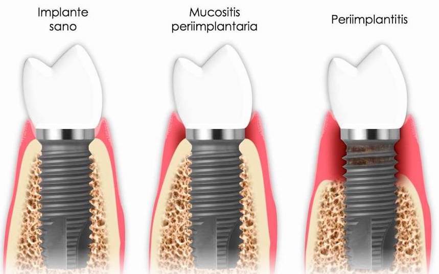 periimplantitis-causas-soluciones