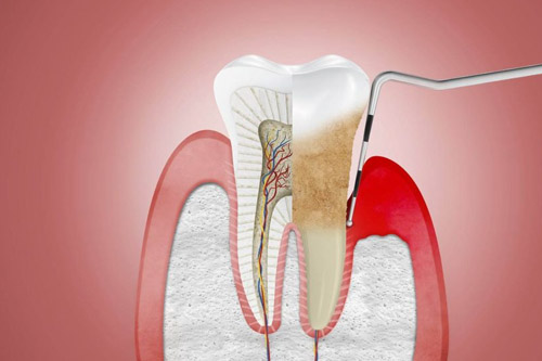 periodontitis-tratamiento-barcelona