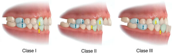 maloclusion-clase-3-tratamiento-ortodoncia