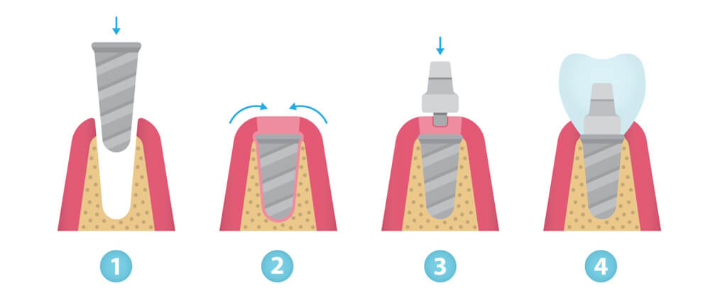 como-se-ponen-los-implantes-dentales