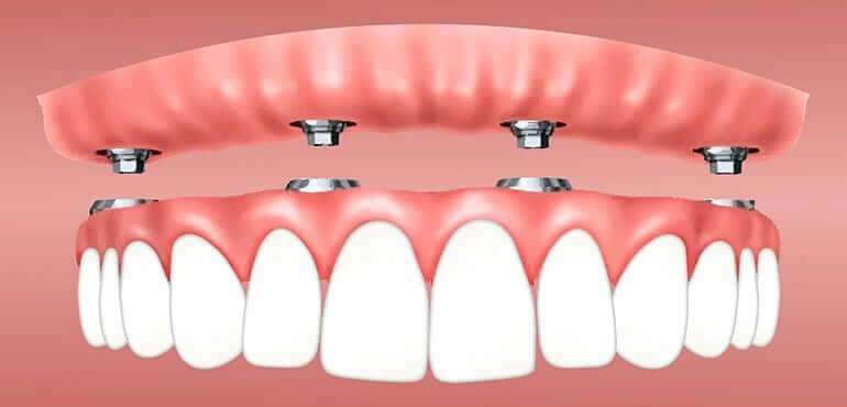 sobredentadura-sobre-4-implantes