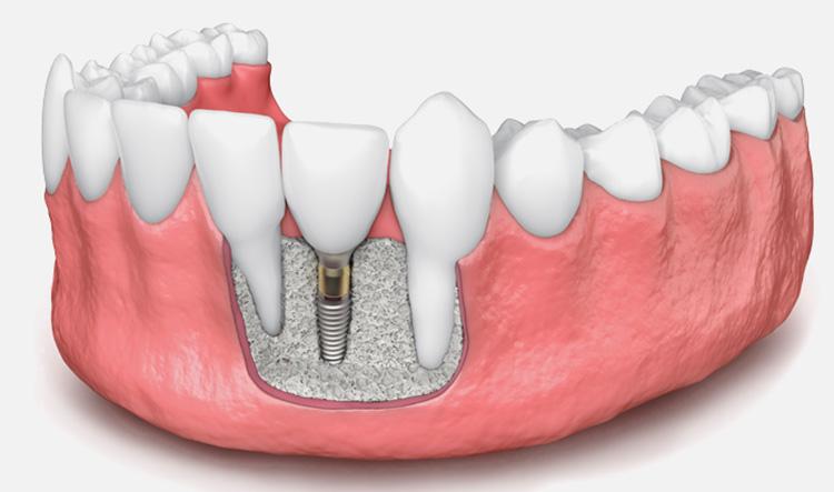 implantes-dentales-sin-hueso