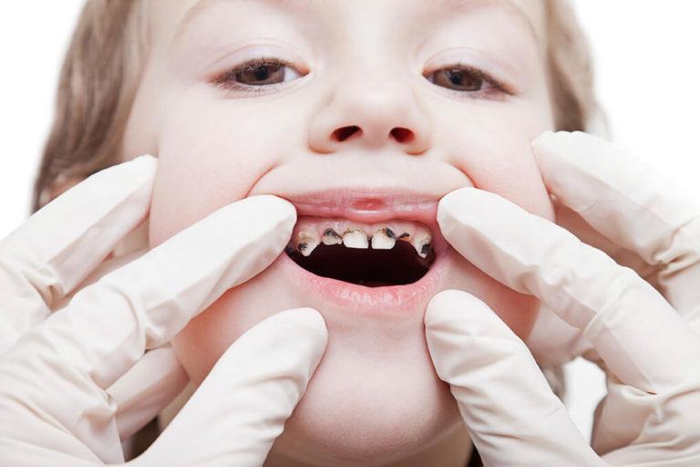 Importancia De La Higiene Dental En Niños| Dental Care Barcelona