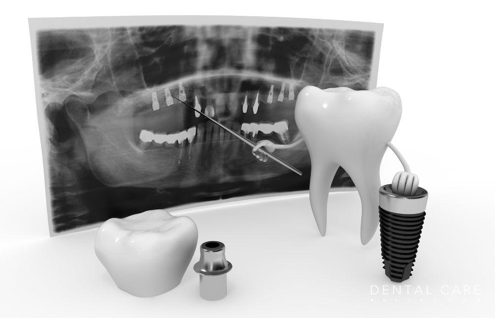 guia-completa-sobre-implantes-dentales