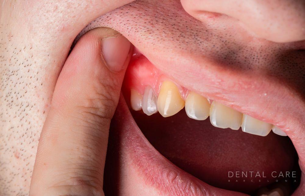 Infecciones Odontogénicas Síntomas tratamientos y prevención Dental Care Barcelona