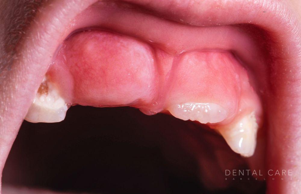 Retraso en la erupción dental: Causas, síntomas y tratamientos en Dental Care Barcelona