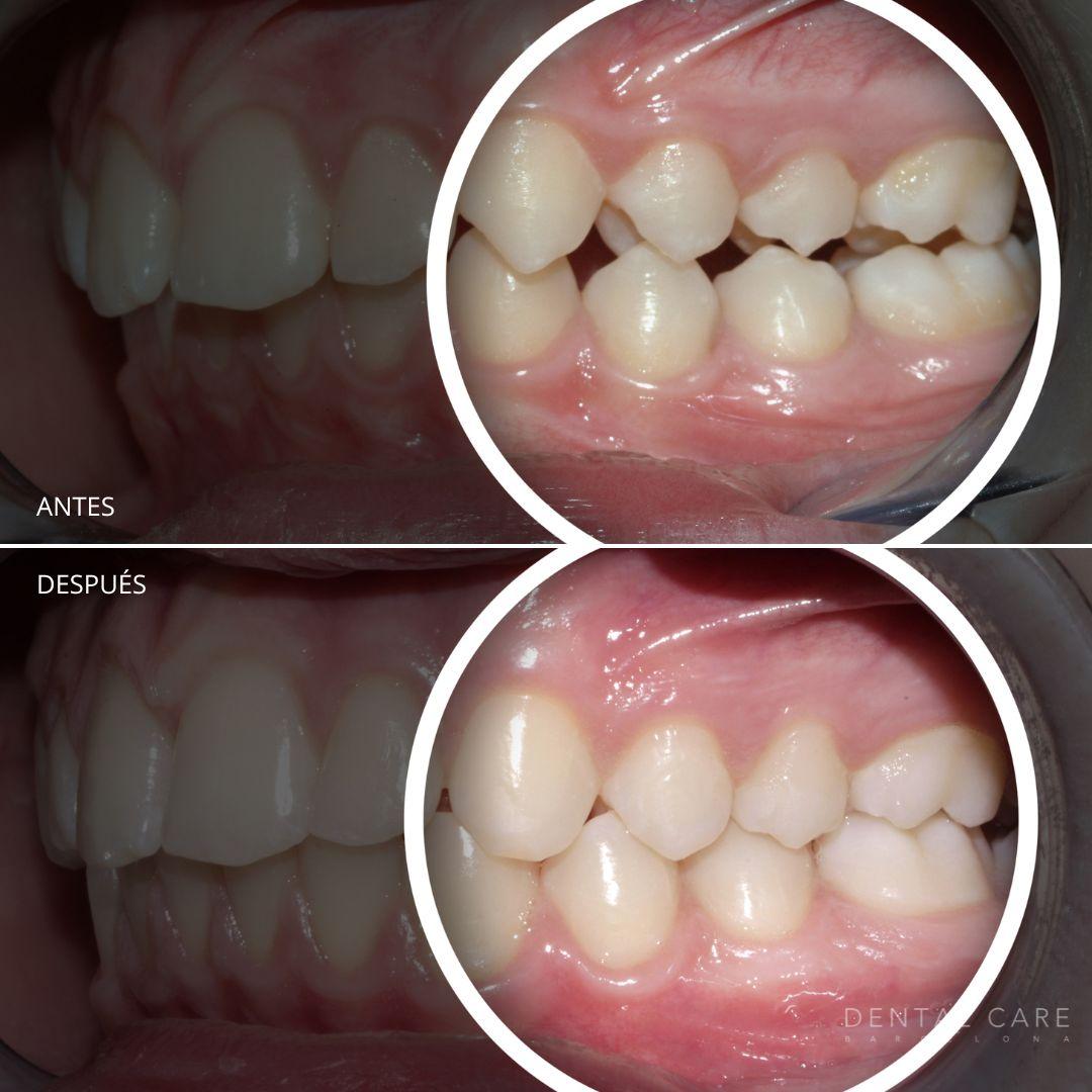 ortodoncia-caso-antes-despues-Barcelona