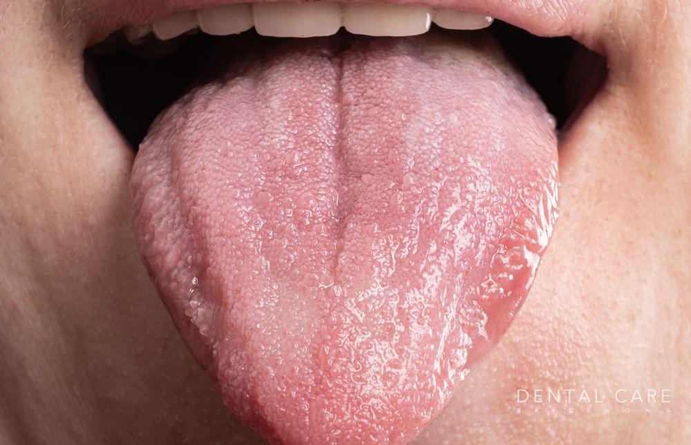 macroglosia-inflamacion-lengua